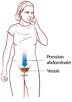 Schéma de la pression abdominale sur la vessie lors de la toux.